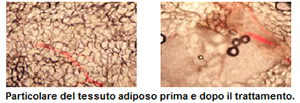 cavitazione-tessuto-adiposo